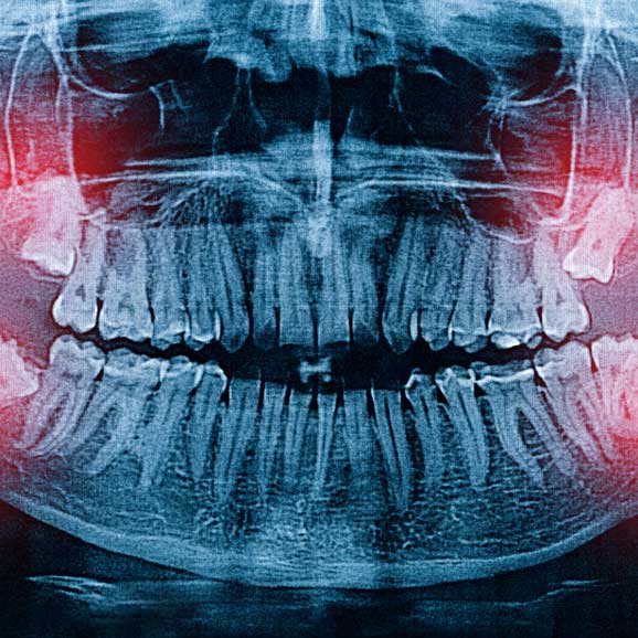 dental x-rays of wisdom teeth