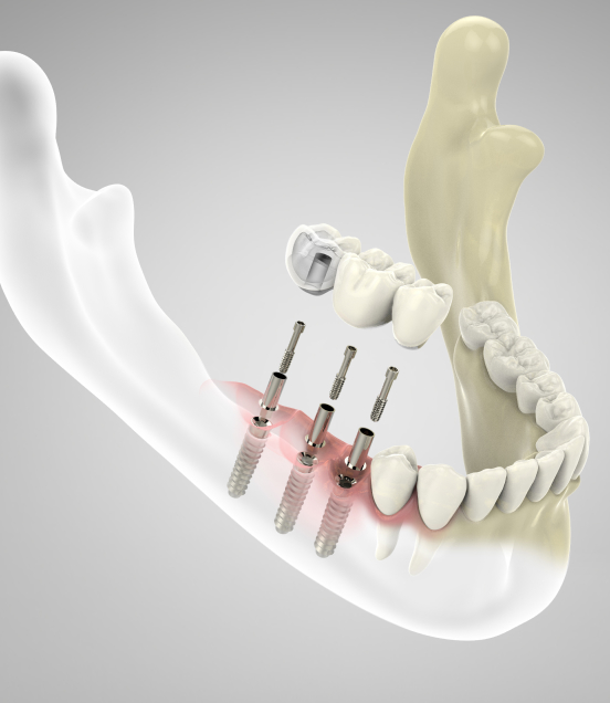 dental implants