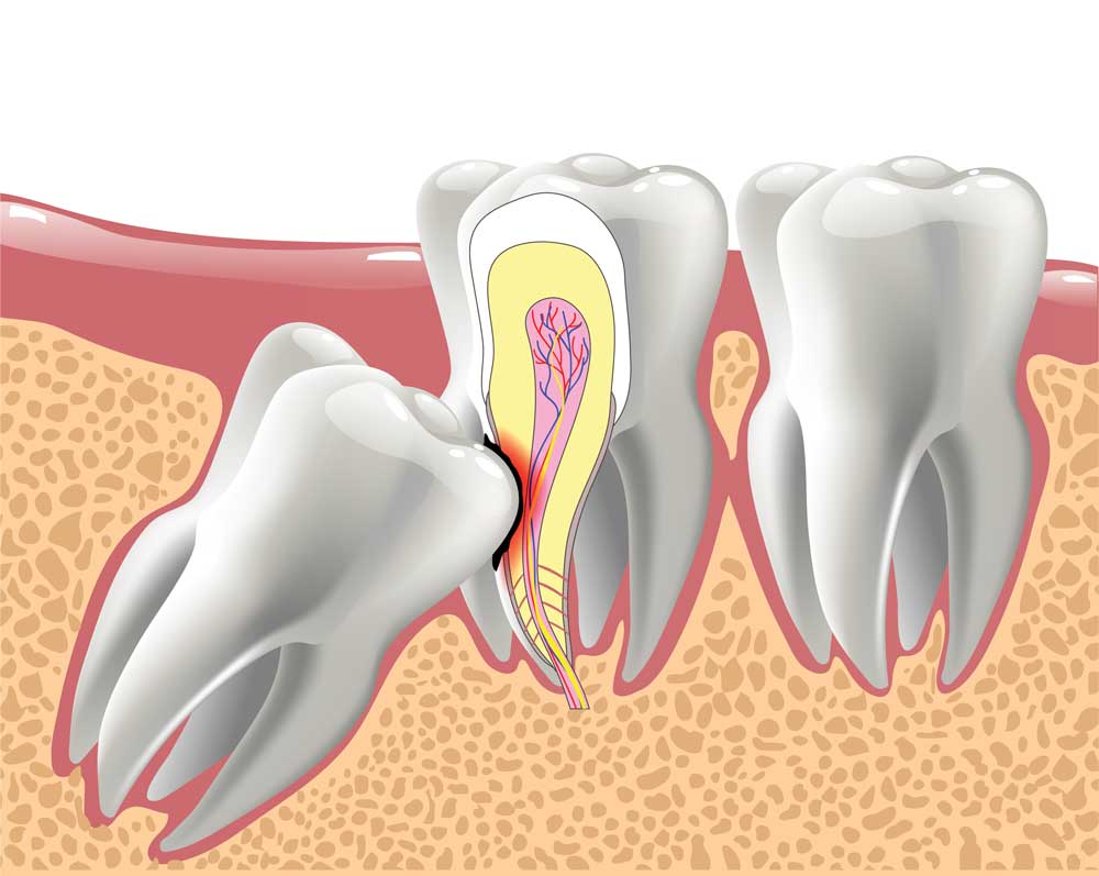 Wisdom tooth pushing against other teeth