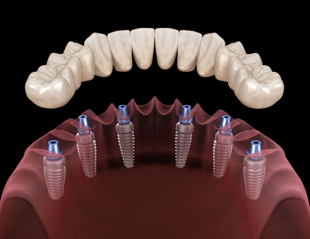 Implant-supported dentures