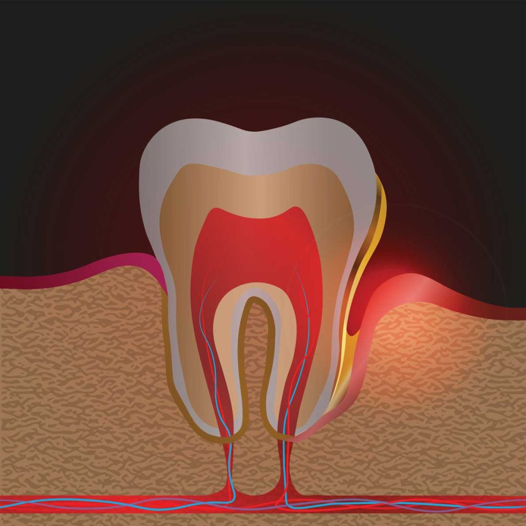 Root canal treatment