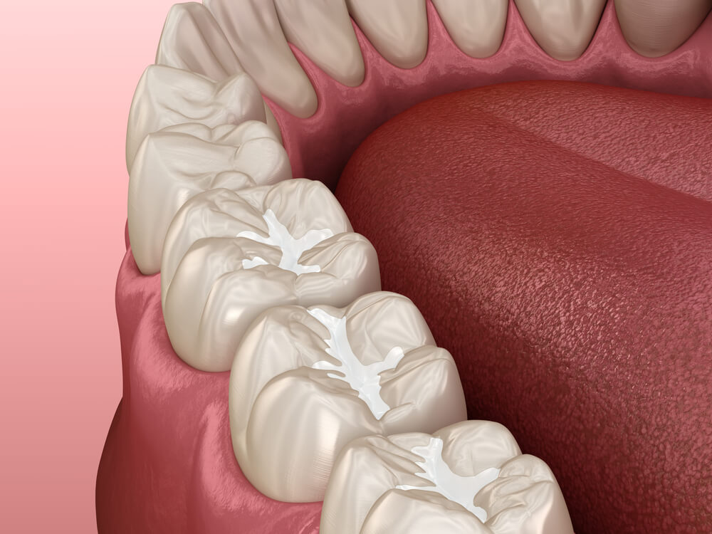 Dental sealants