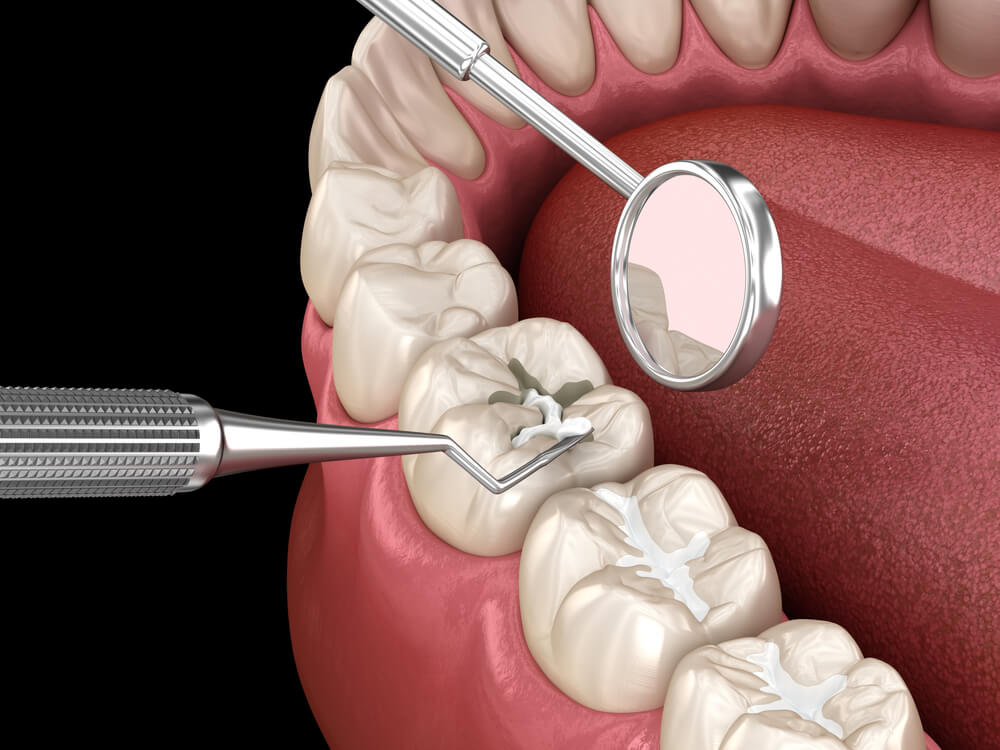 Dental sealants being applied to the molars