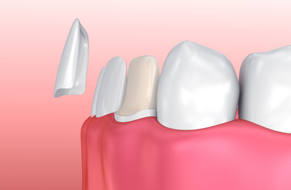 Porcelain veneers