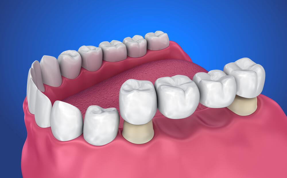 Dental bridges being placed