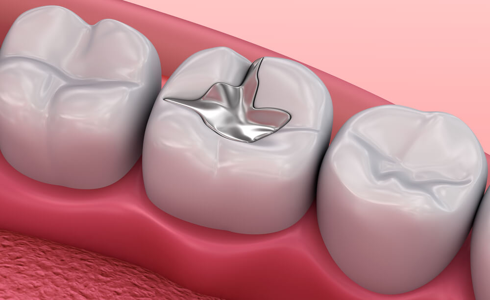 Silver dental fillings